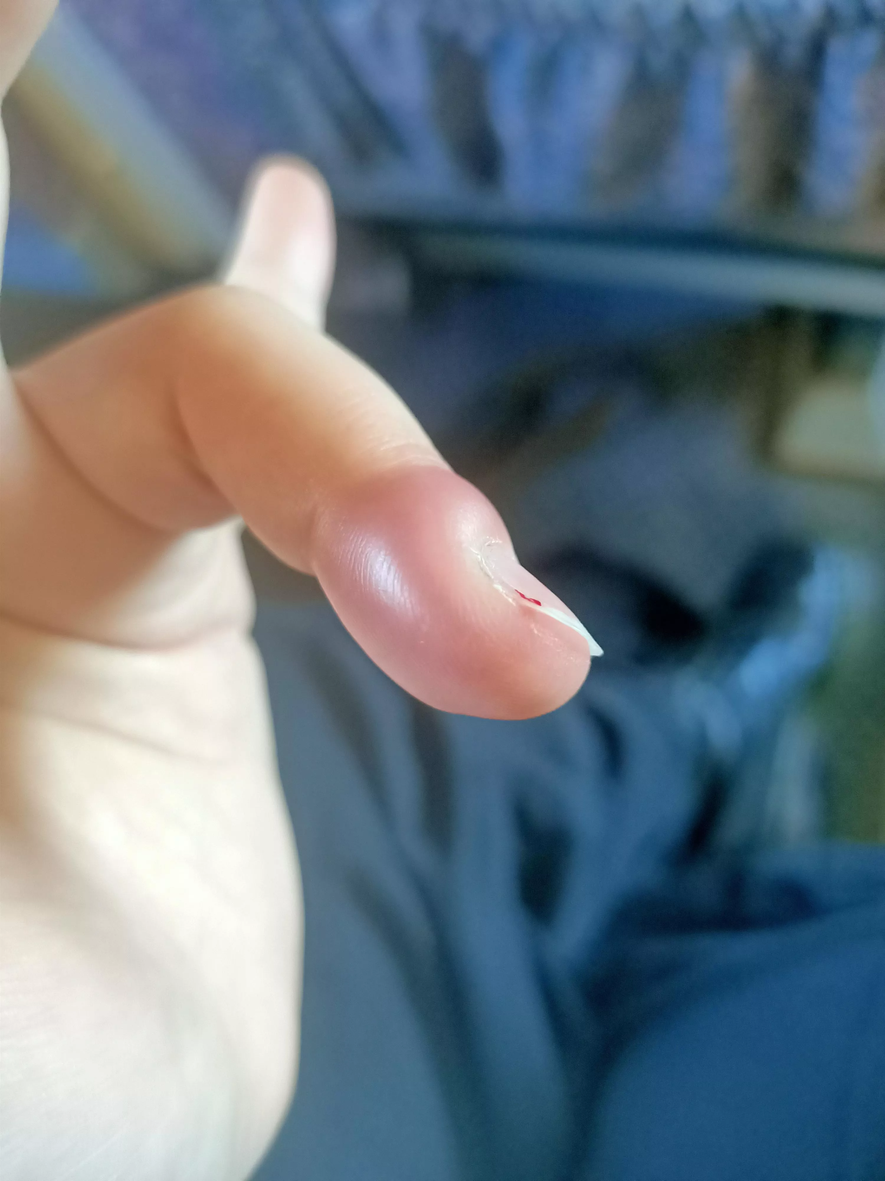 This weird thing on my finger. It's excruciating, and seems to be getting worse. Headed to the GP today, but figured you guys would find it interesting. posted by MrNissanCube