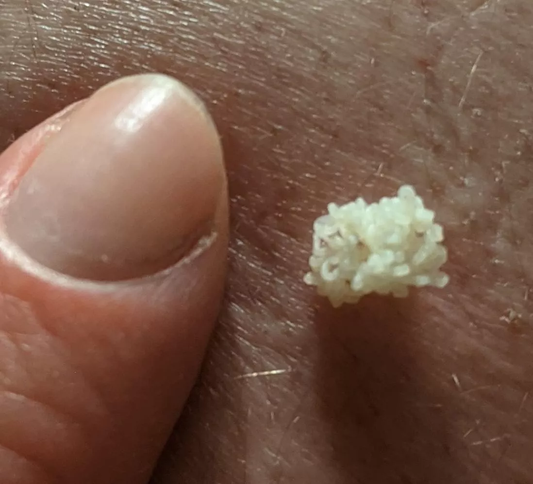 Thought y'all would enjoy this beautiful coral cloud that came out of a neverending blackhead on my bf's back (it refills every few months, thankfully) posted by madamebasilbuttons