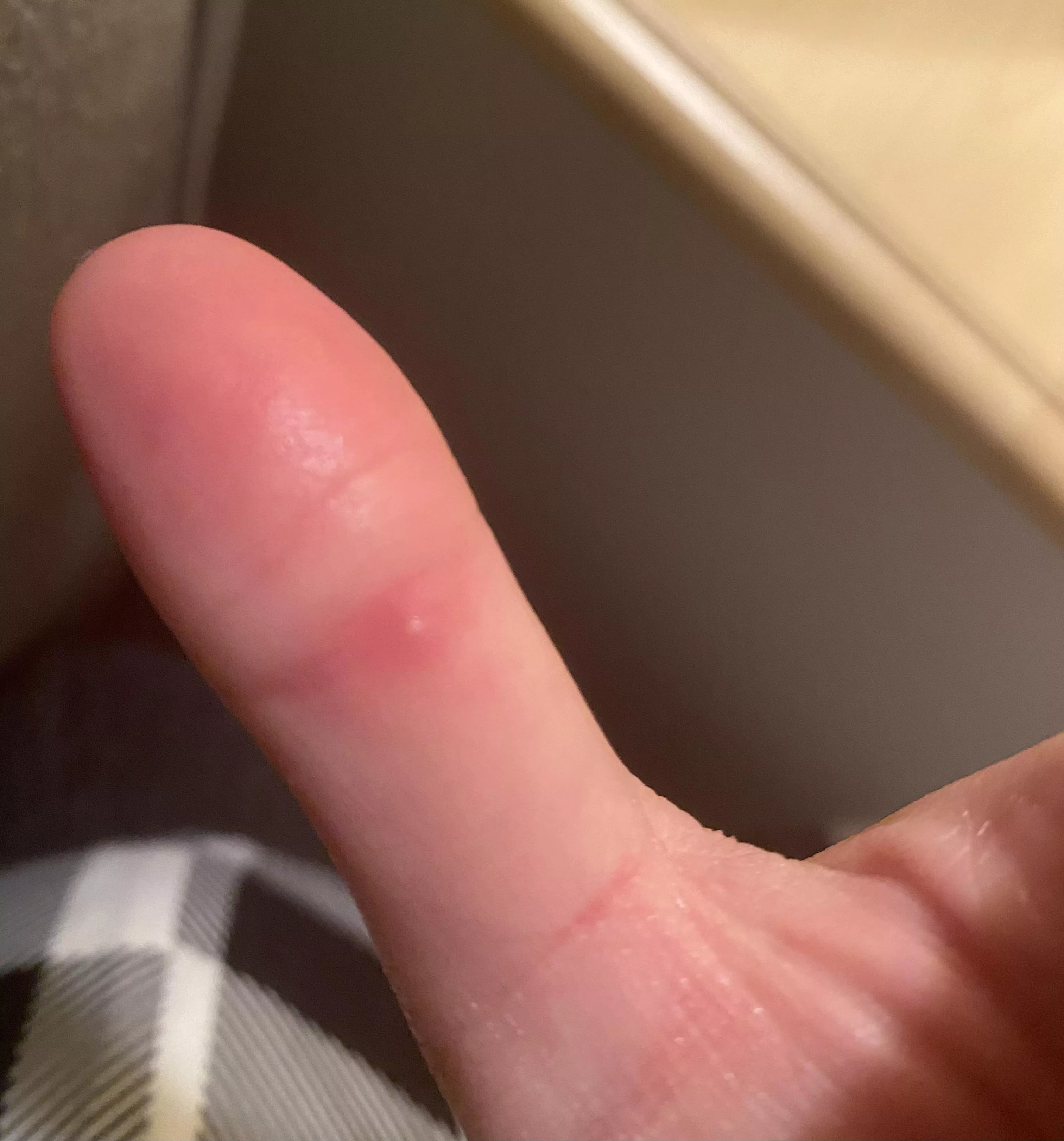 Tiny, painful, hard white bump right on the inside of the knuckle on my thumb. This is what I presume is a forbidden pop… has anyone else gotten something like this before? It hurts like mad to bend my thumb. It’s hard to see but the center of the bu posted by naynzaa