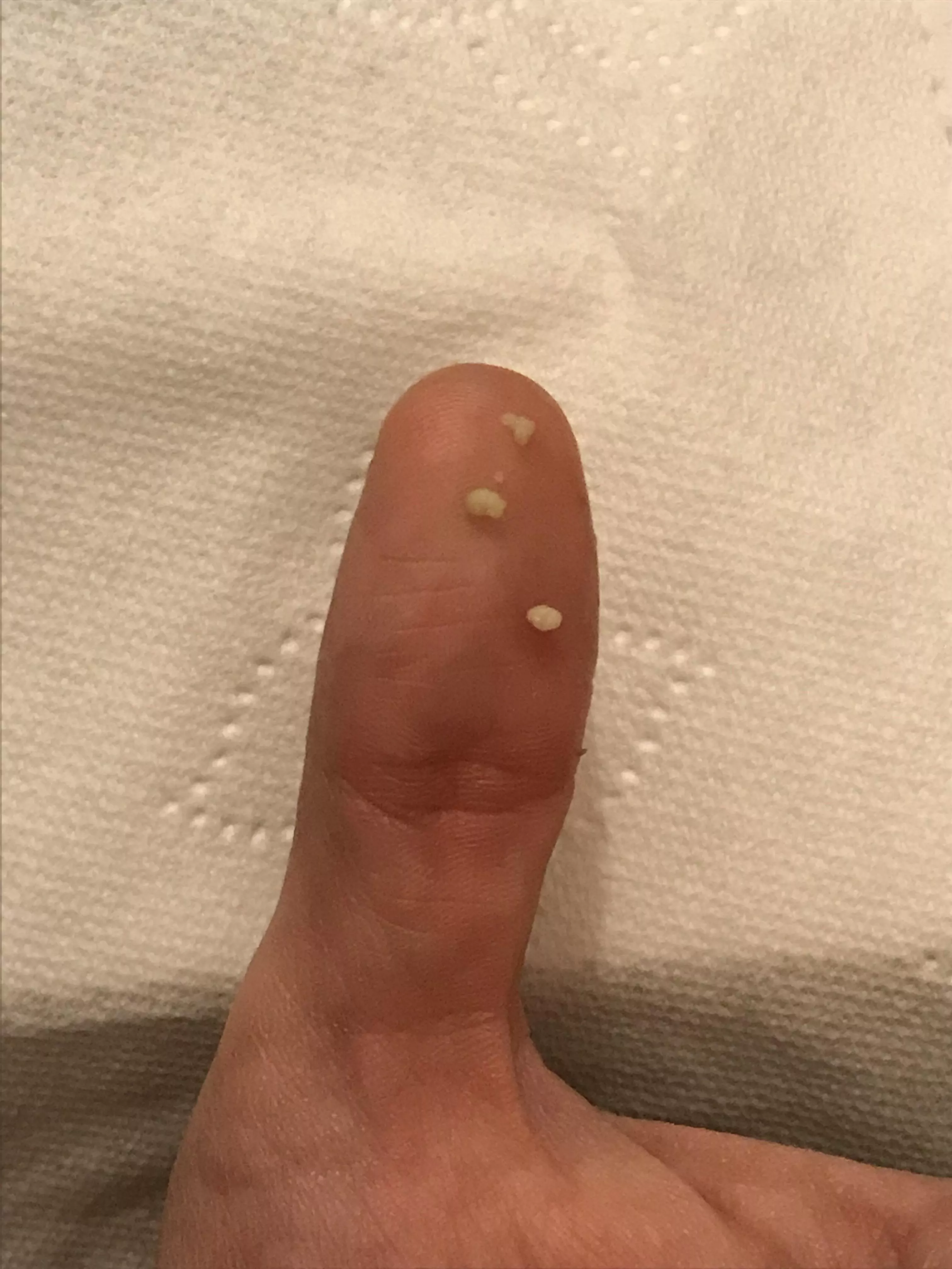 Today’s Tonsil Stone Haul posted by mommabear44