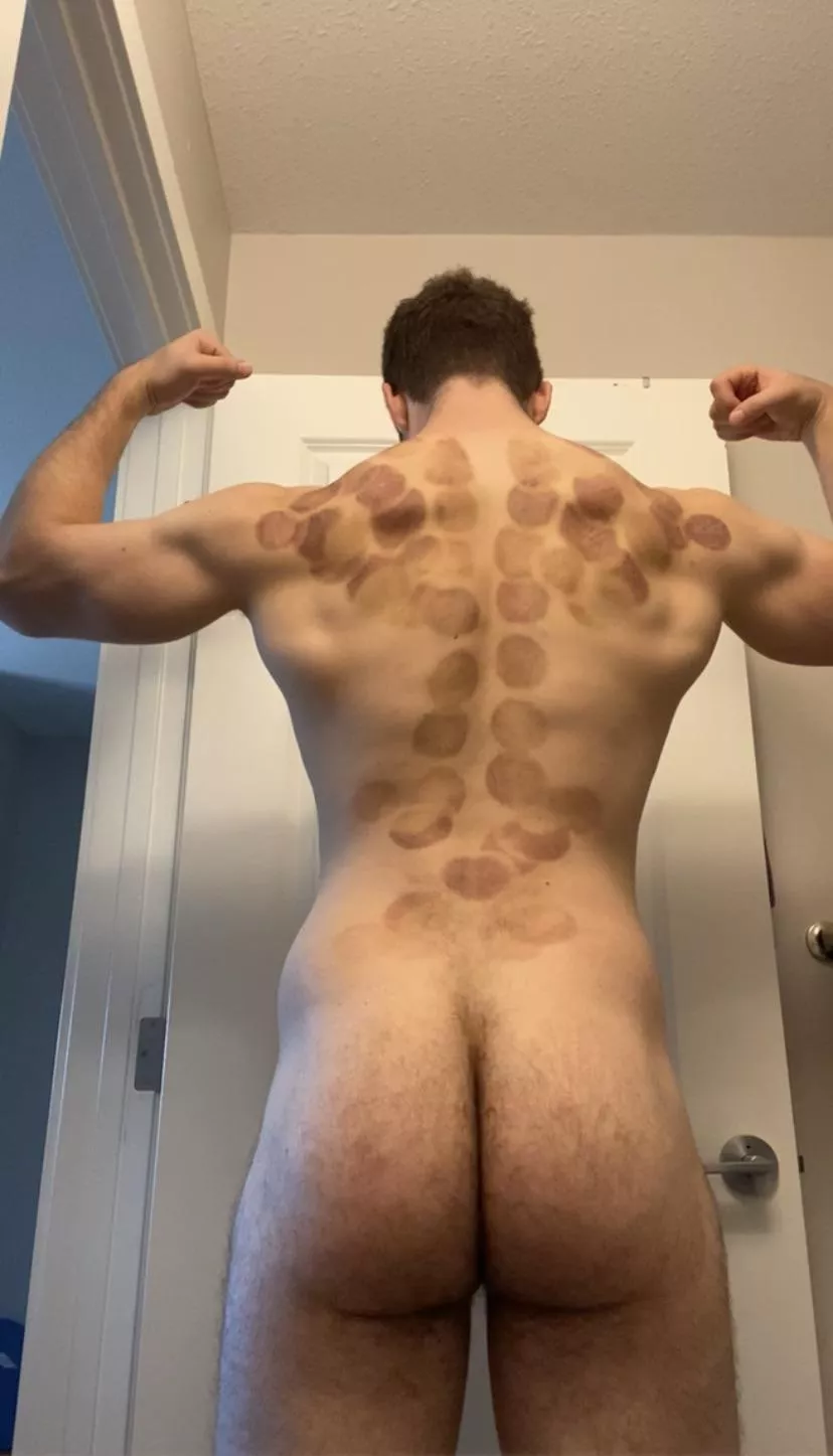 Tried cupping and I think my massage therapist went a little over board lol posted by Jackpackage71