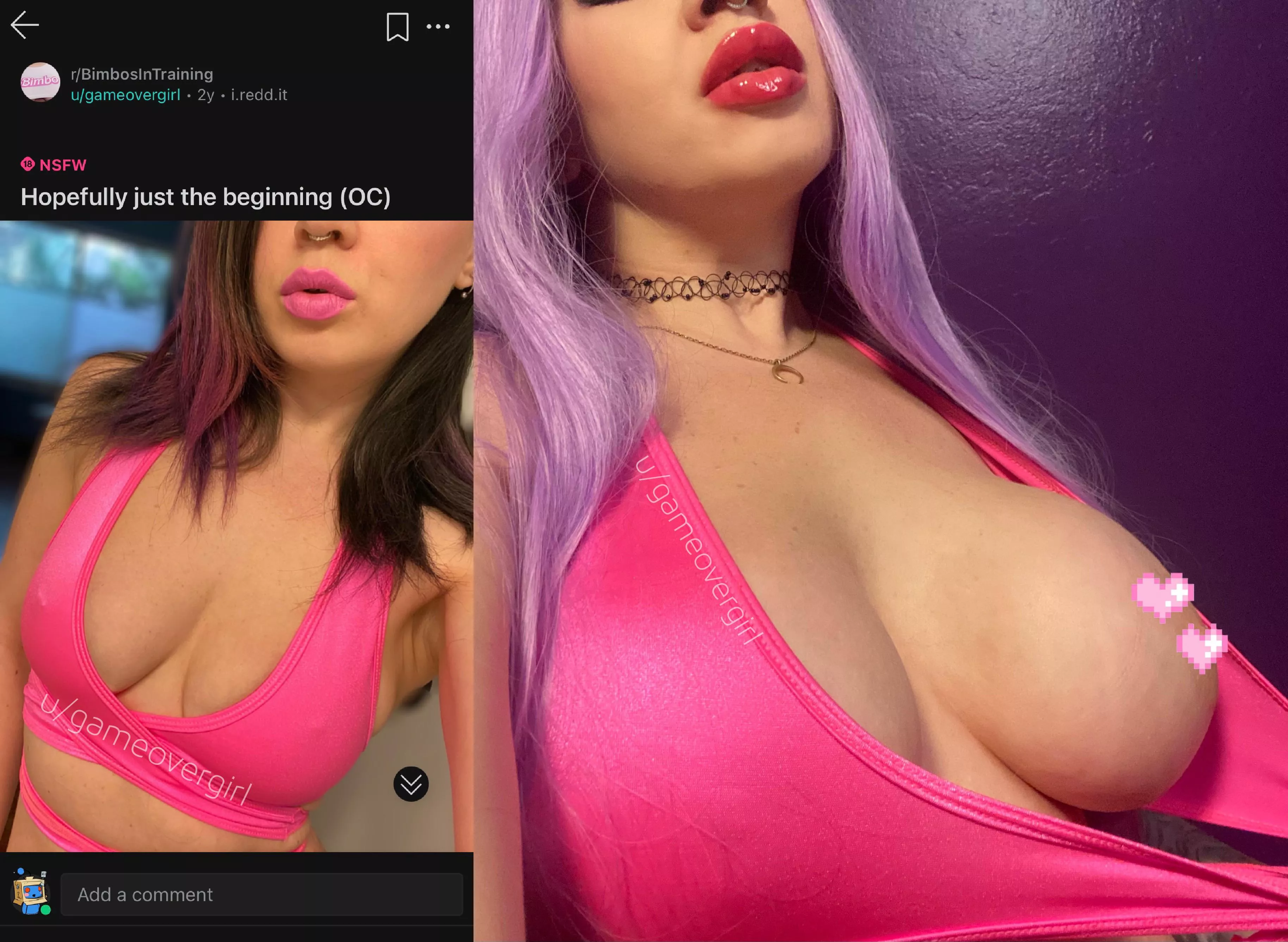 Two years later 💖 injected lips and bolt-on tits (550cc XL expanders) posted by gameovergirl