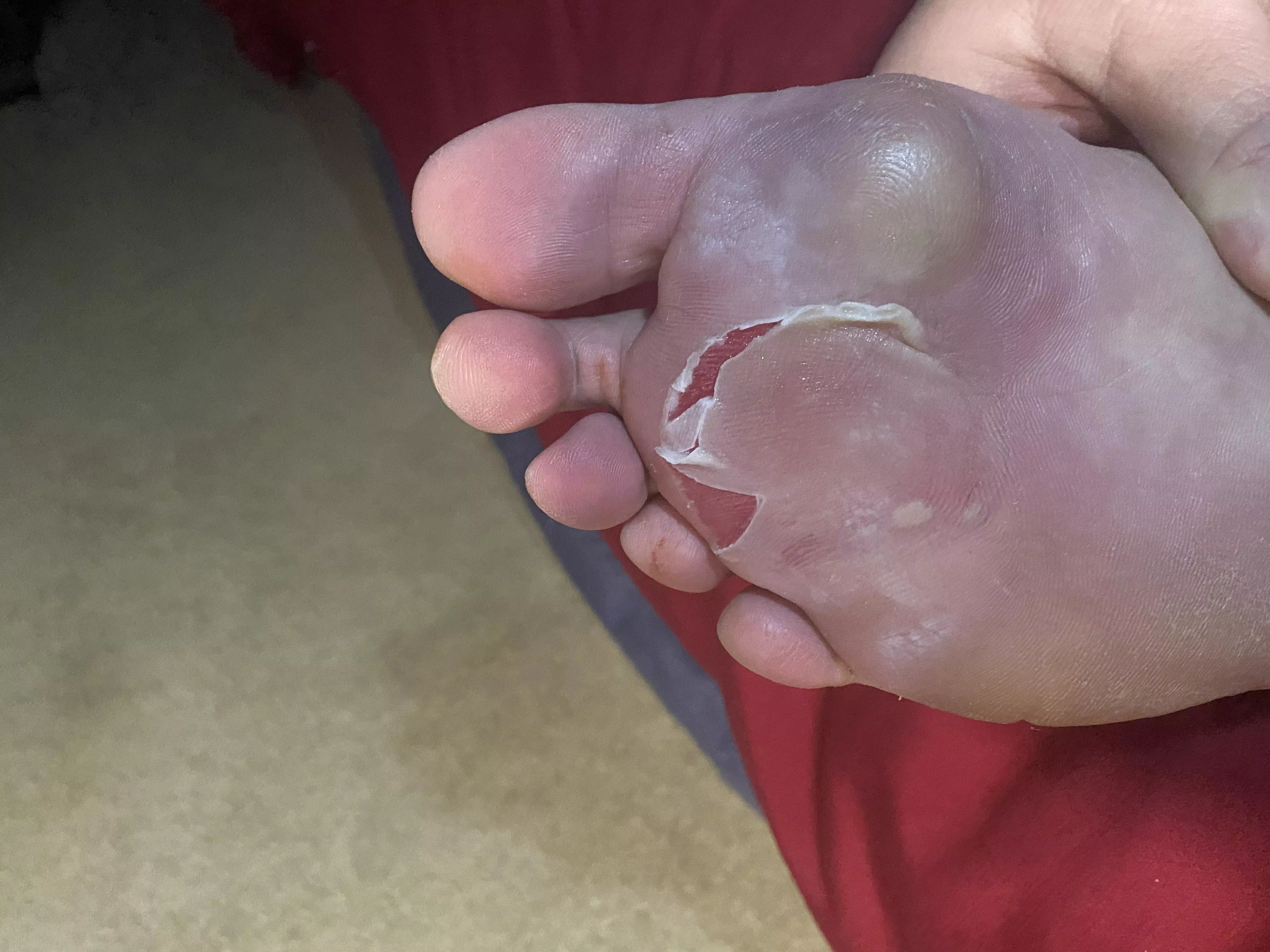 Unintended blister pop posted by evil_chainsaw