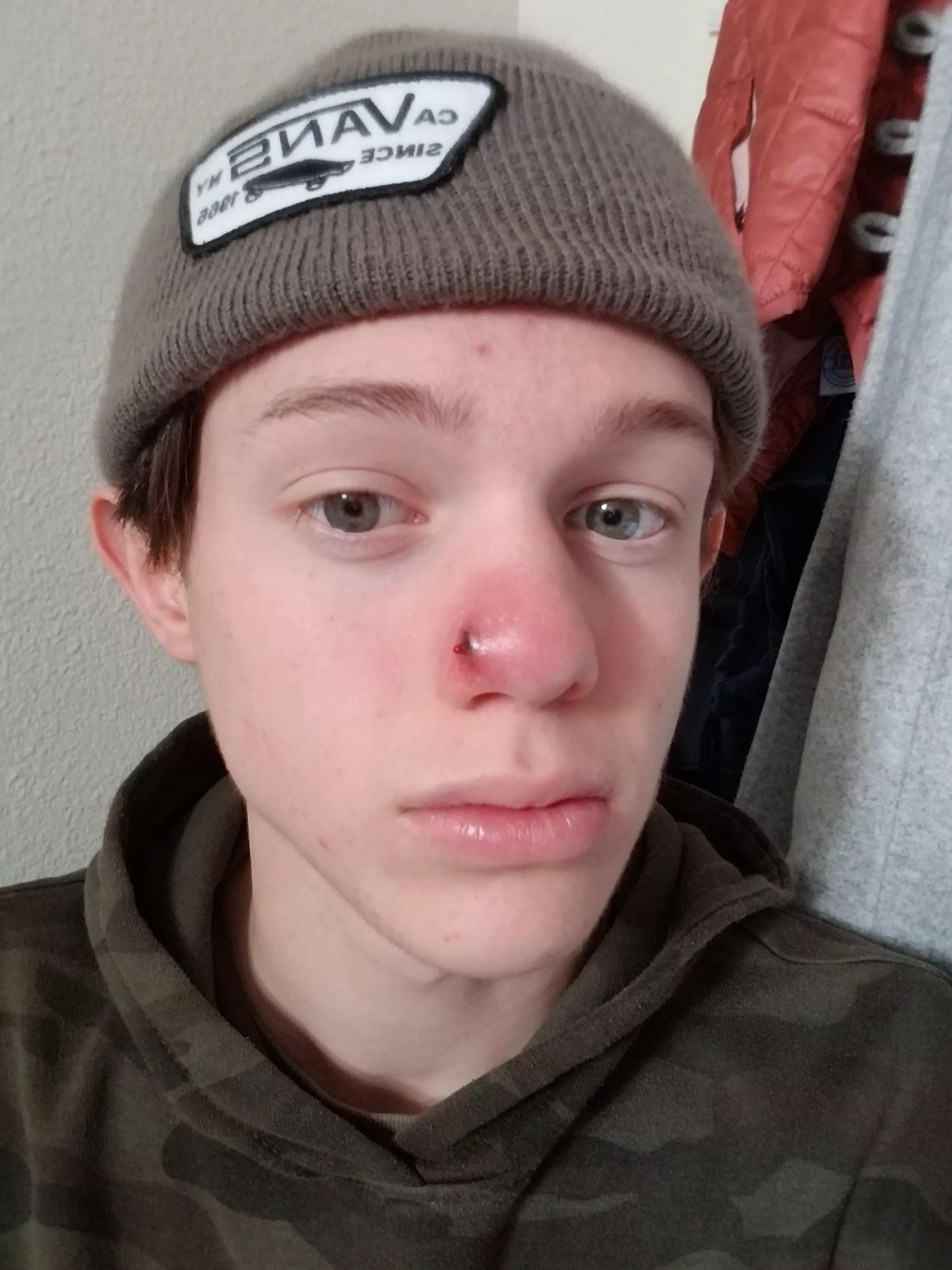 Update: it started draining about an hour before going to Urgent Care and the doctor squeezed a bit and gave me an oral antibiotic prescription. I'm sorry I didnt record it. Also here's another hat for you cornballs. posted by AlextheDio