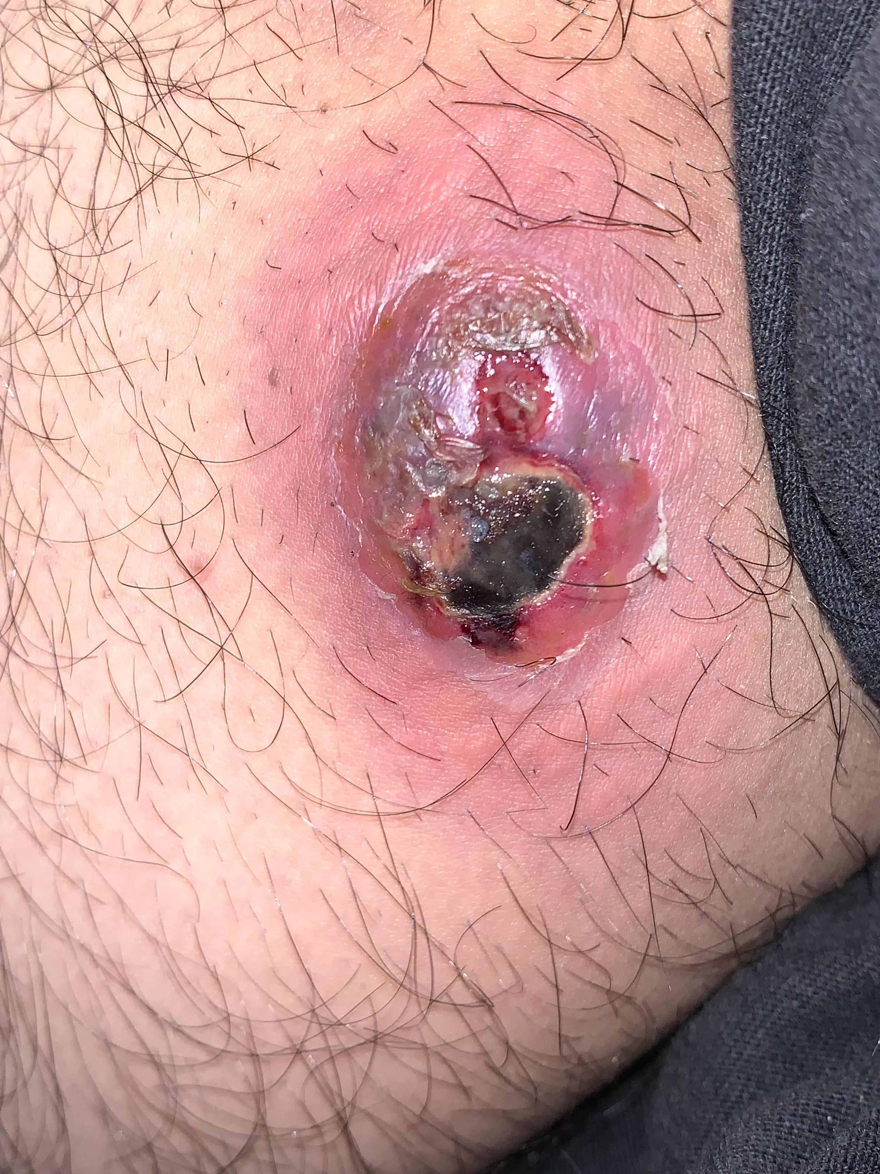 Update on my boil,I am currently on antibiotics posted by 19ex