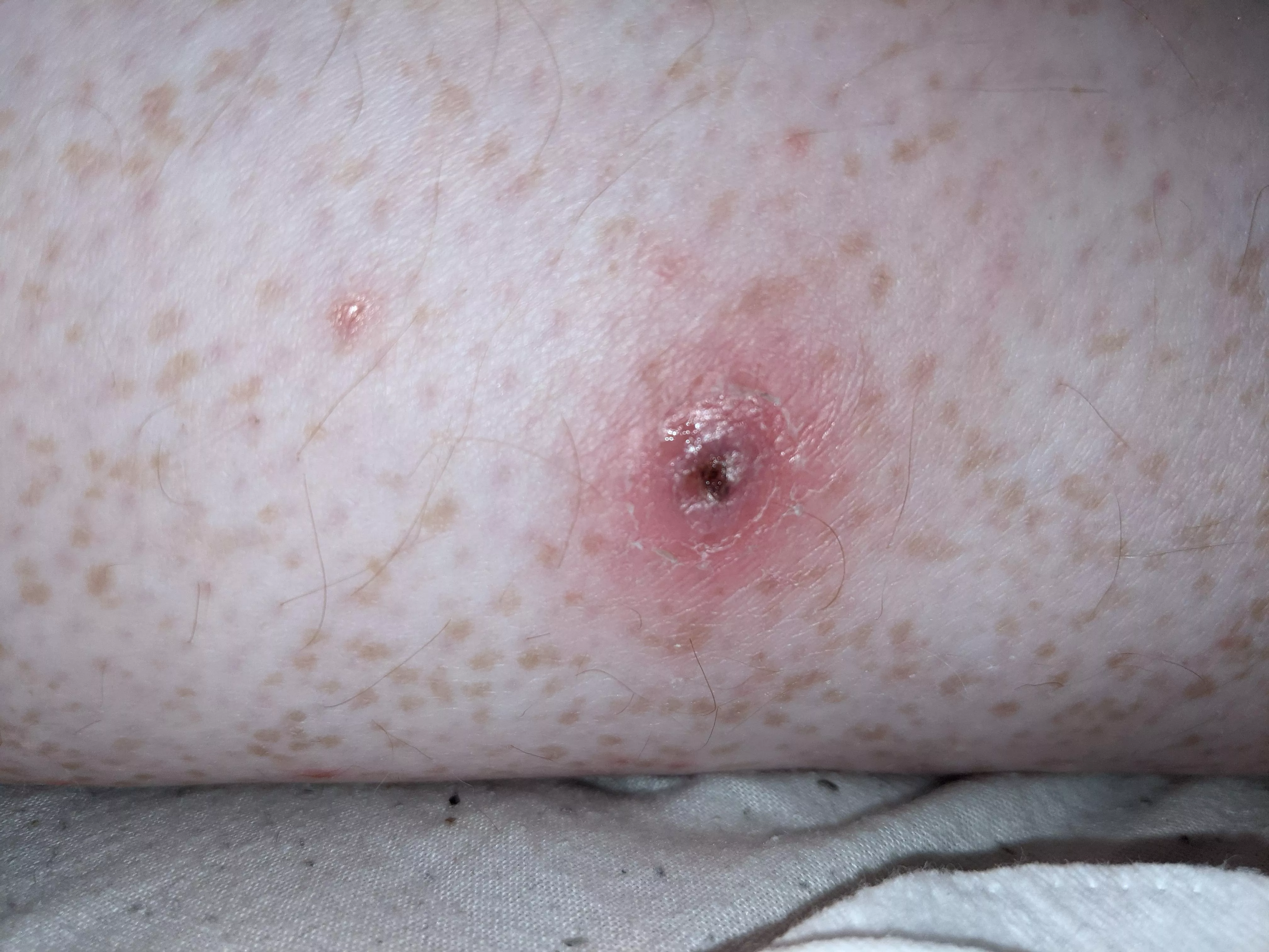 Waiting for the gp to call me back about this little fucker. Had it about a week now, keeps refilling and popping. I'm guessing some kind of skin infection but not 100% sure. posted by mellymooooo