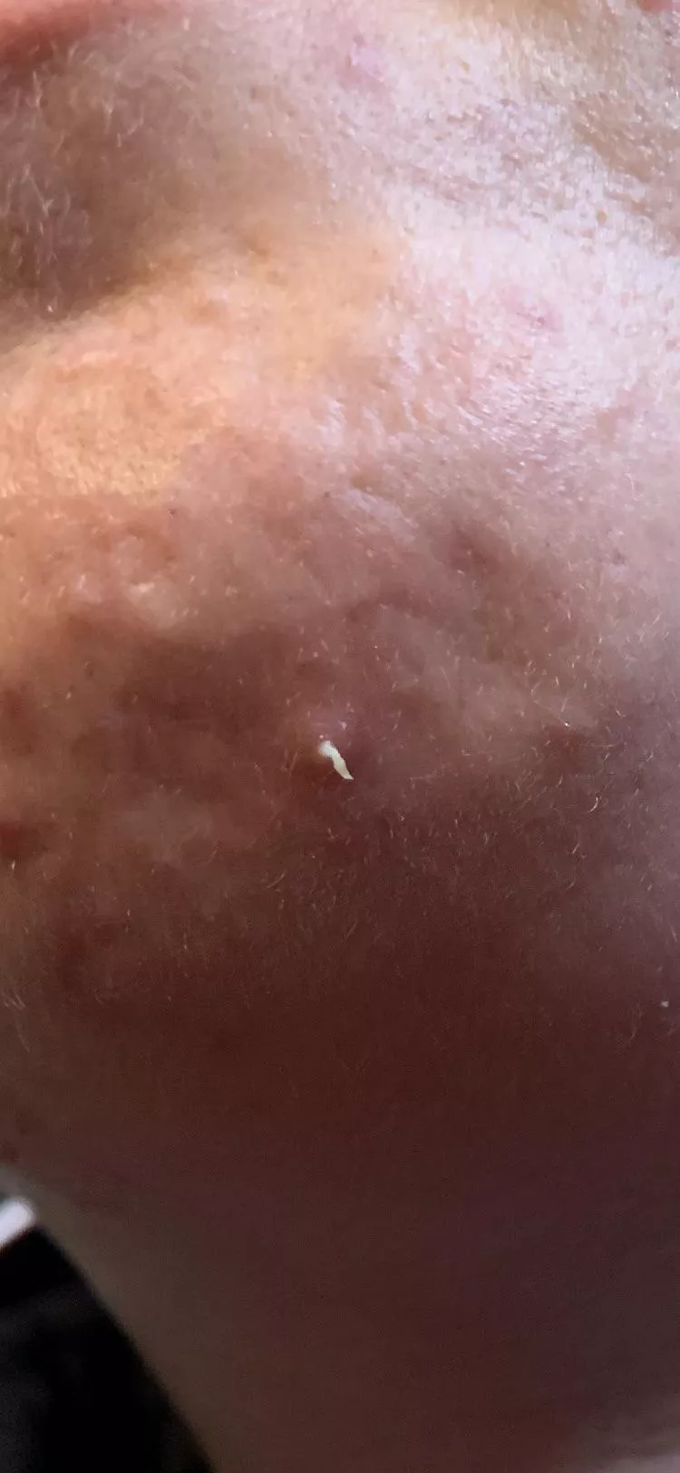 Weird pop on my chin posted by iusestolivein