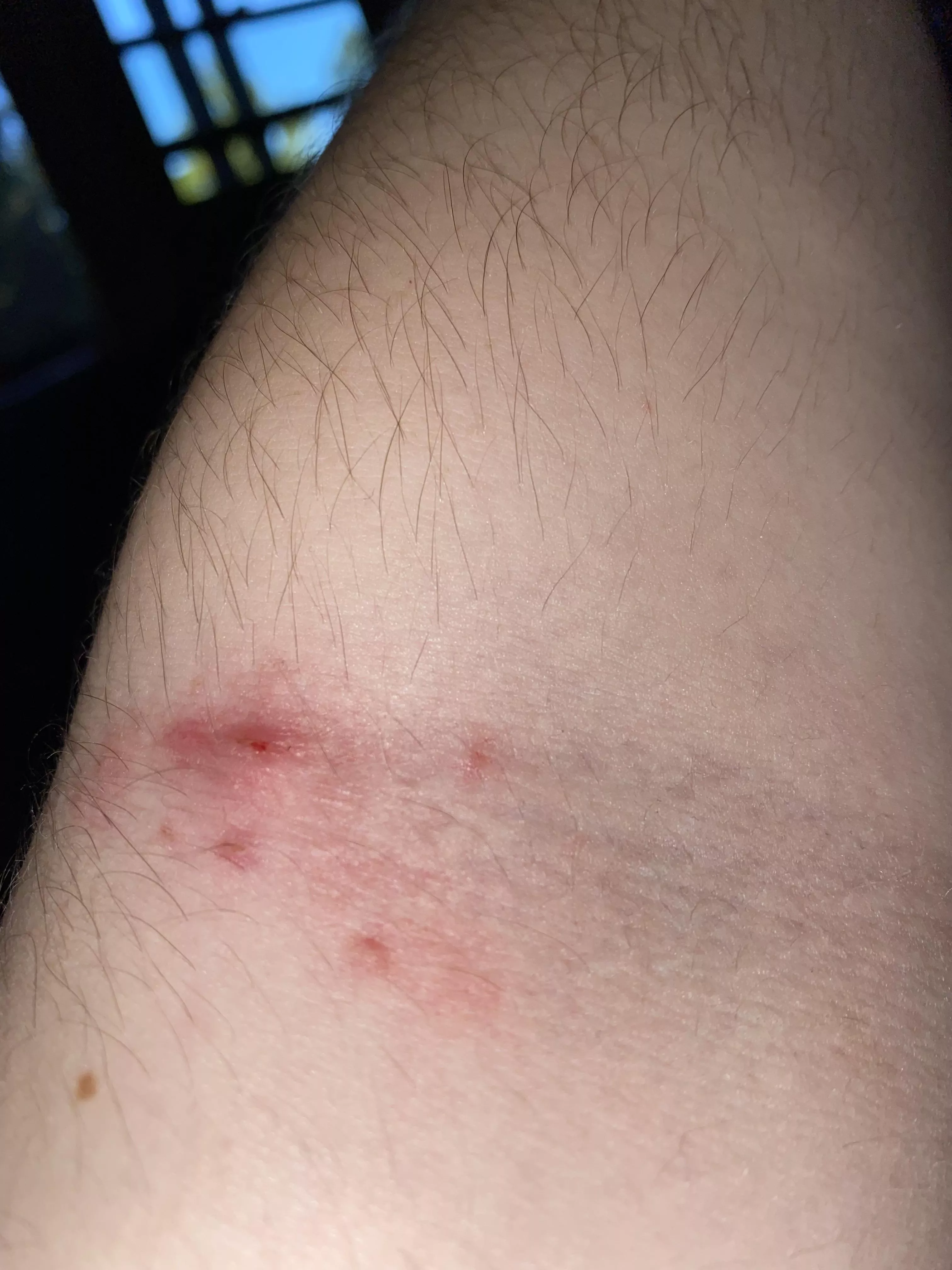 weird spot on the inside of my elbow that keeps refilling. super uncomfortable since its where i bend my arm. posted by qvennie