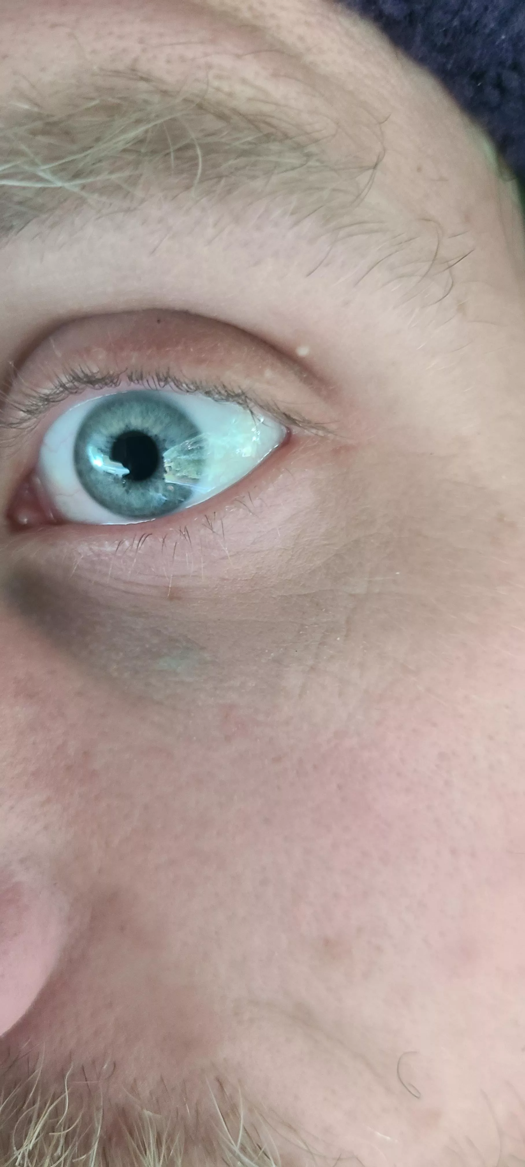 What are these things on my eyelids? They don't pop and aren't sore or anything. Had them for a year or so, maybe longer. posted by Willing_Still_9516