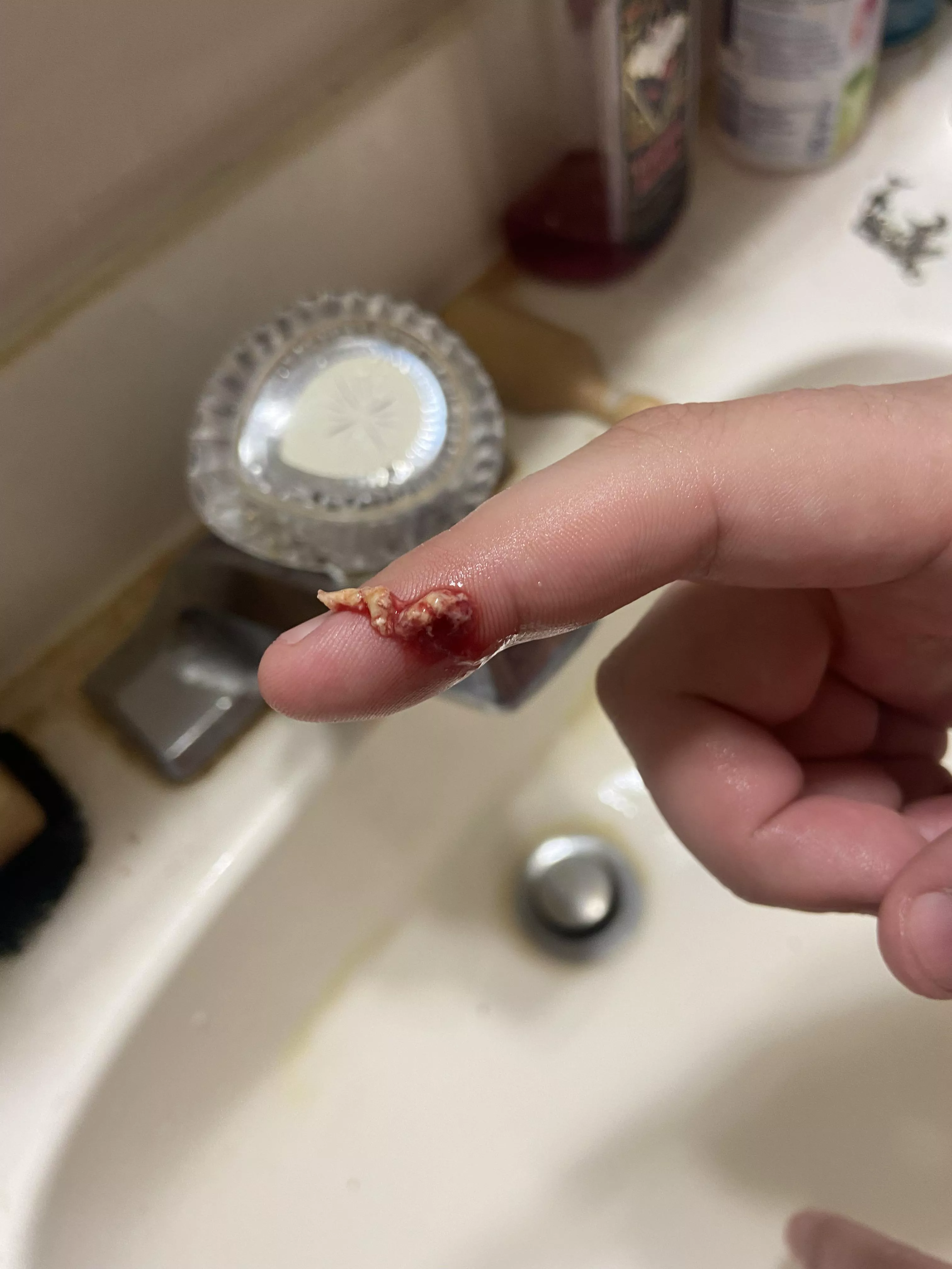 What came out of an Infected pimple/boil (no video unfortunately) posted by One-Trick-Tuna