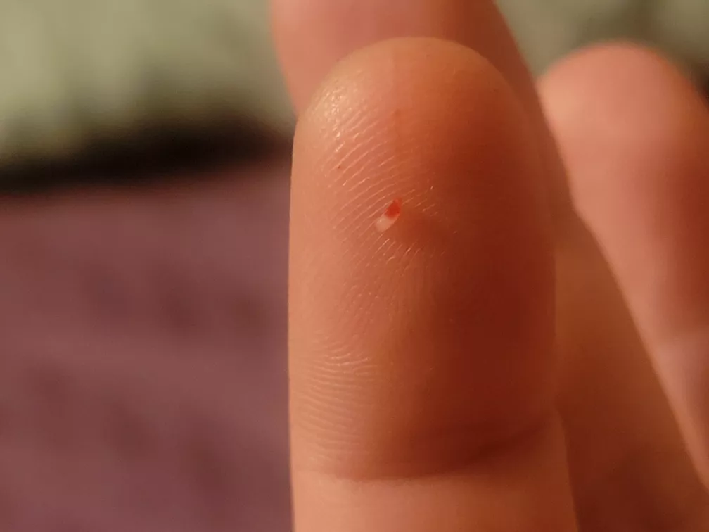 What is this? I get these hard sores for weeks and finally have to dig this little fucker out. The sores heal around it otherwise. Photo of hole in comments. posted by Whatsyallsopinion