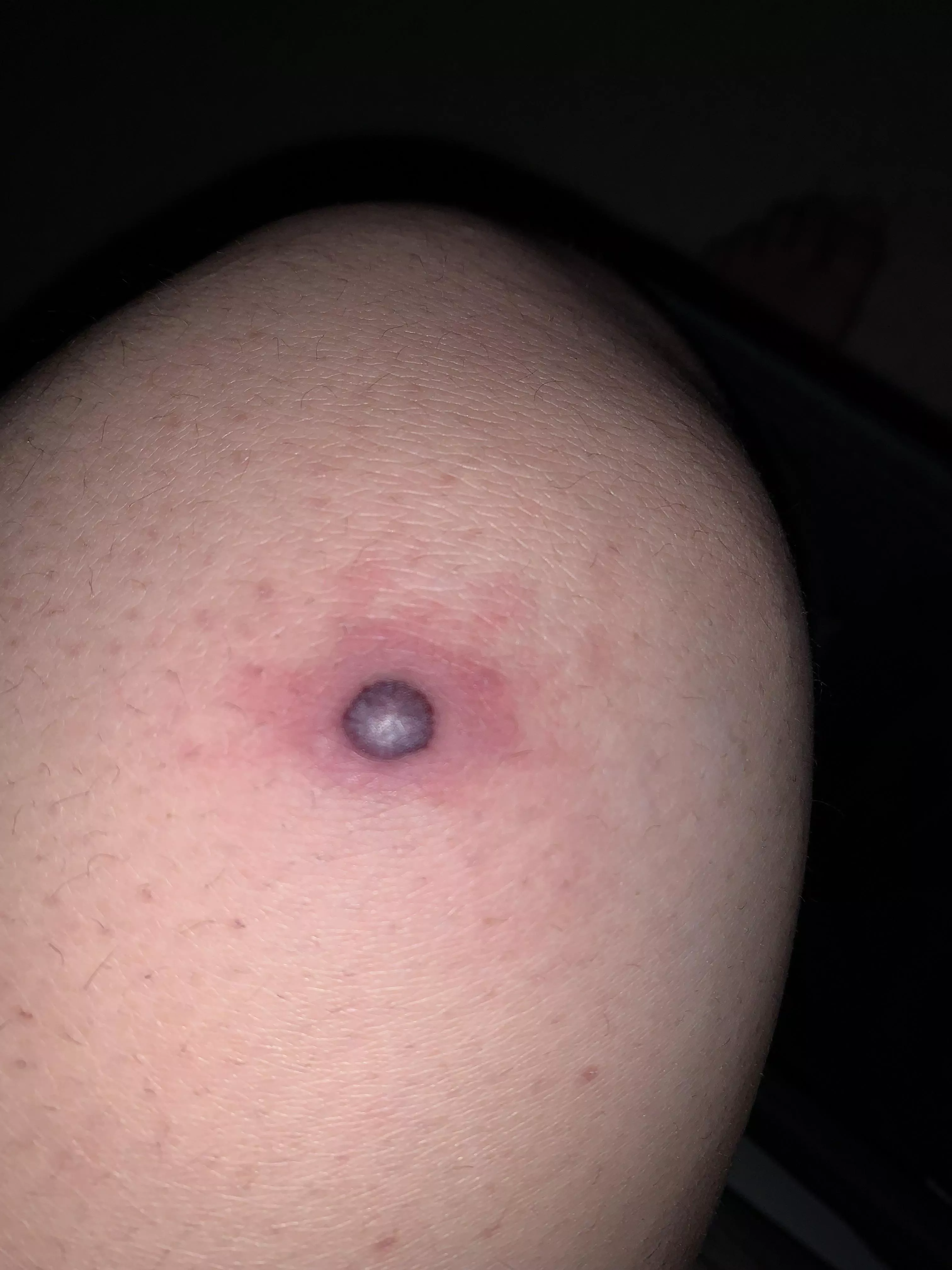 What is this? It’s like a blood filled pimple on my knee but I don’t know what could have caused it. posted by gordonche