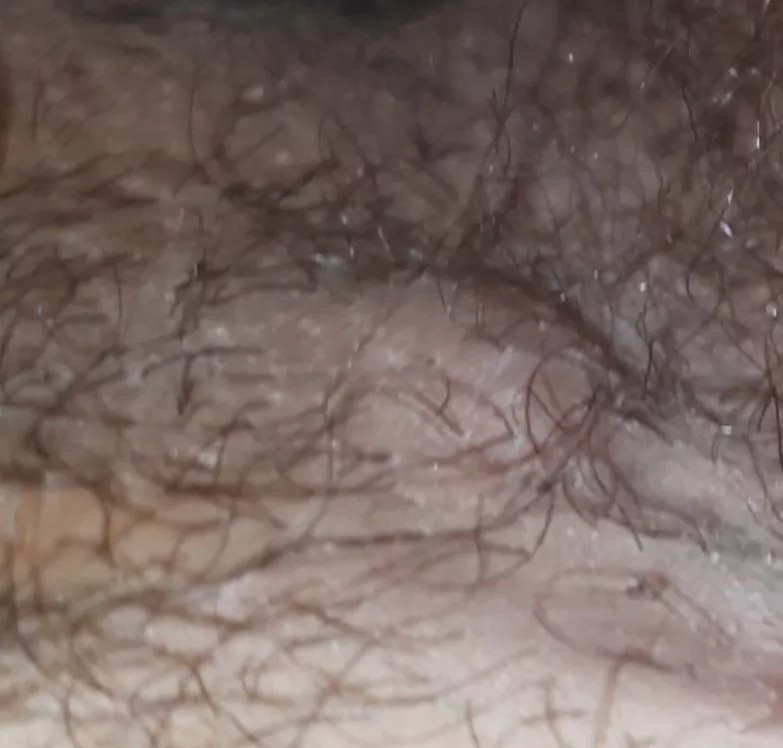 WHAT IS THIS(its near my pp and inner thigh) posted by Robertovyy