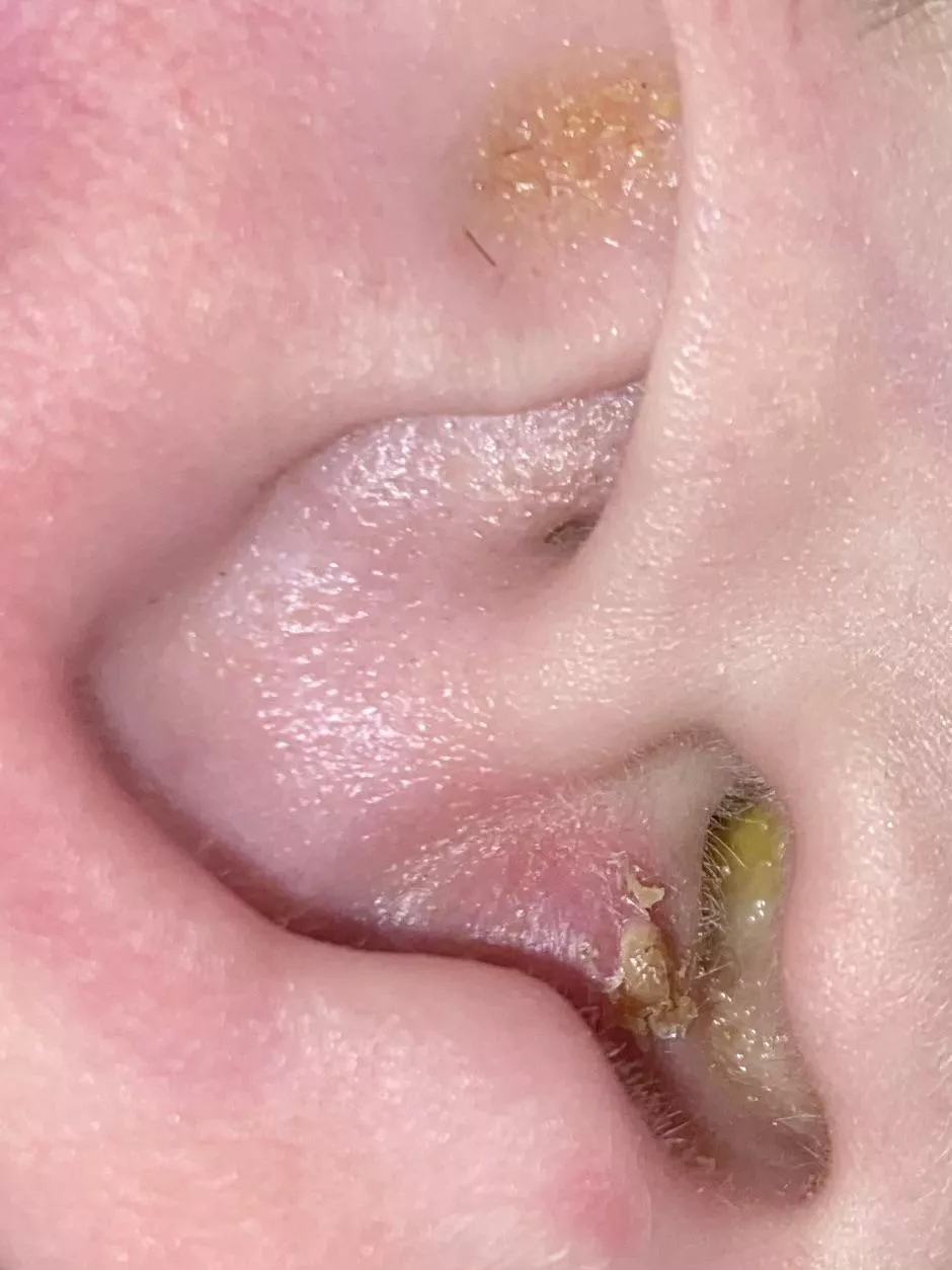 Where to start on my boyfriend’s ear… posted by casecar