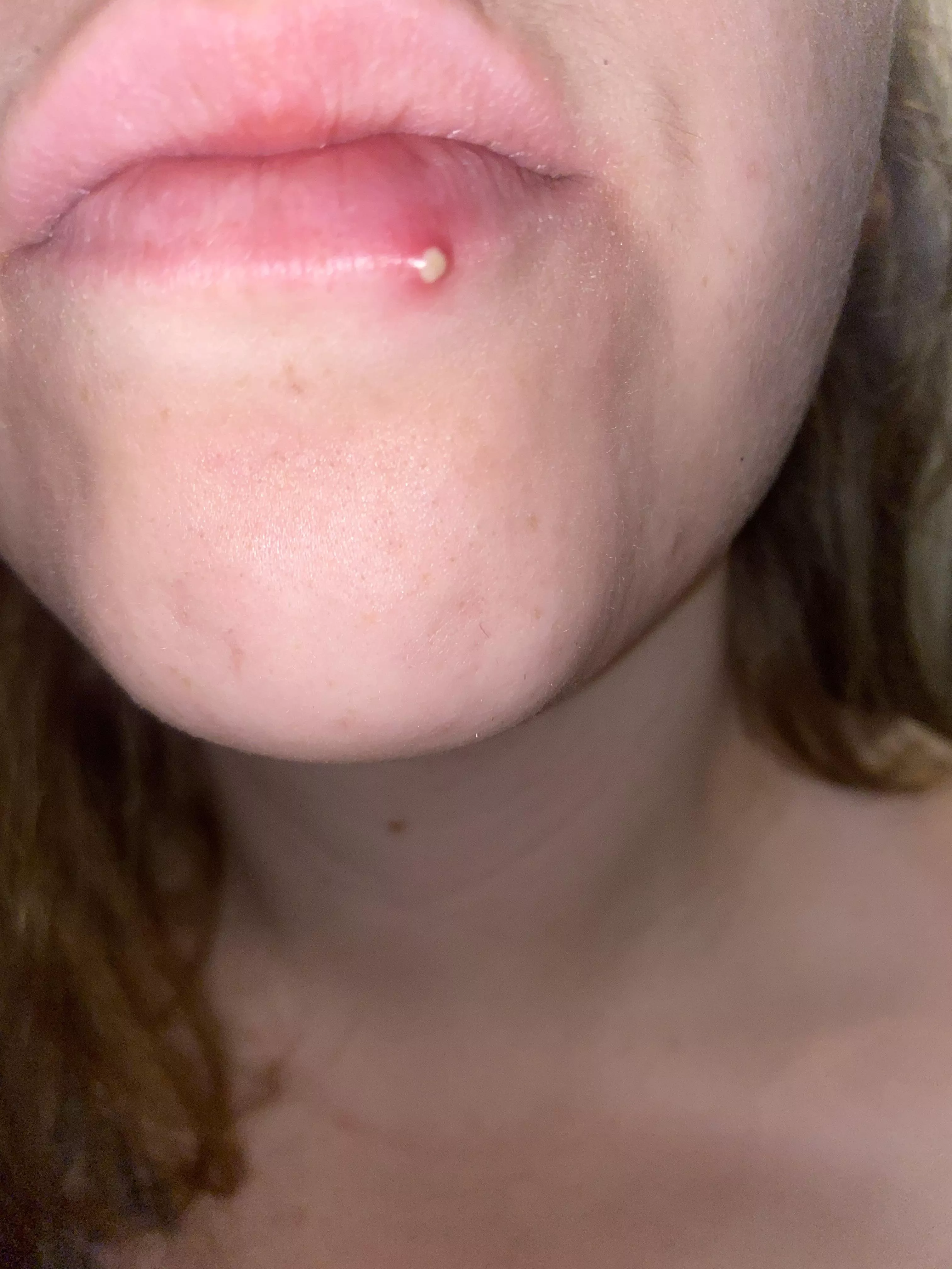 Woke up to this lip pimple! I could feel it grow throughout the night, but was surprised to see how white it was this morning! Maybe I’ll take a video of popping it. posted by LadyPlantQueen